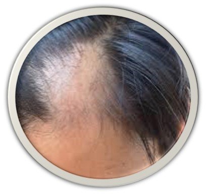 AlopeciaAndrogeneticaH 1