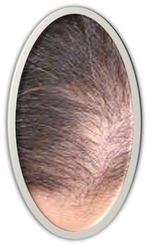 AlopeciaCeliaquia