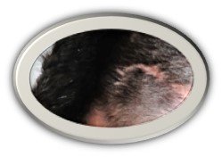 AlopeciaCicatricial